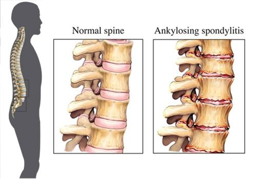 How Can I Cured My Ankylosing Spondylitis - Wellcure.jpg