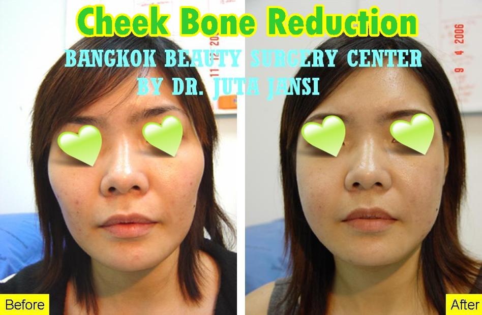 Cheekbone Reduction