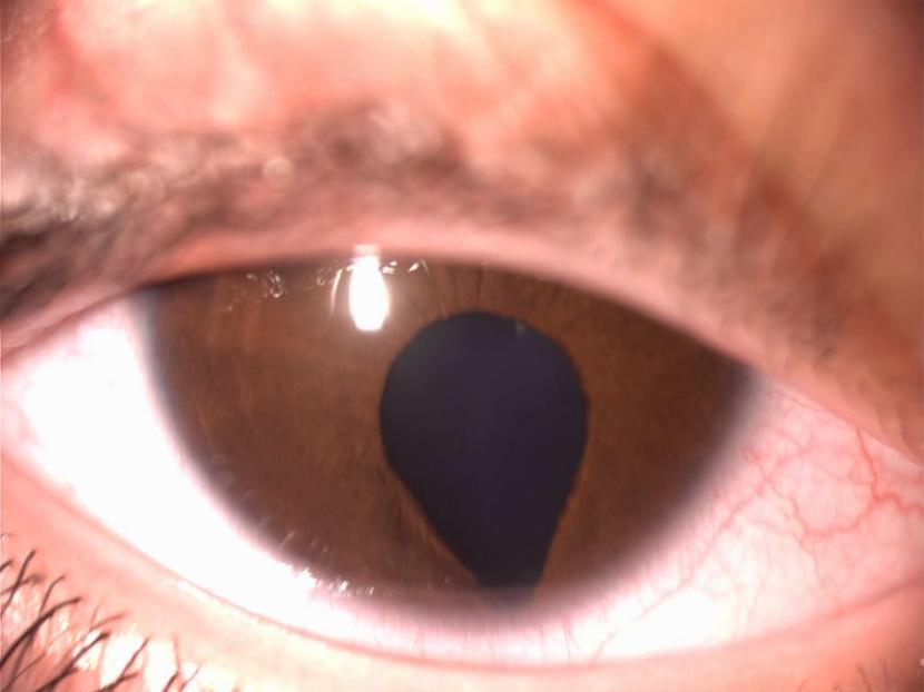 Coloboma