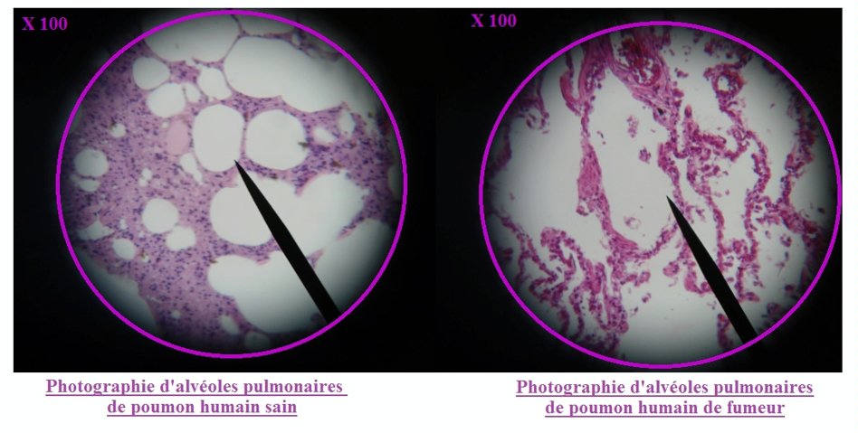 comparaison de coupes de poumon sain et poumon d'un fumeur