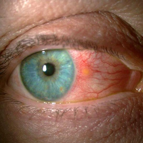 Conjuntivitis flictenular