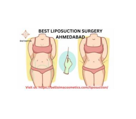 LIPOSUCTION SURGERY AHMEDABAD.jpg