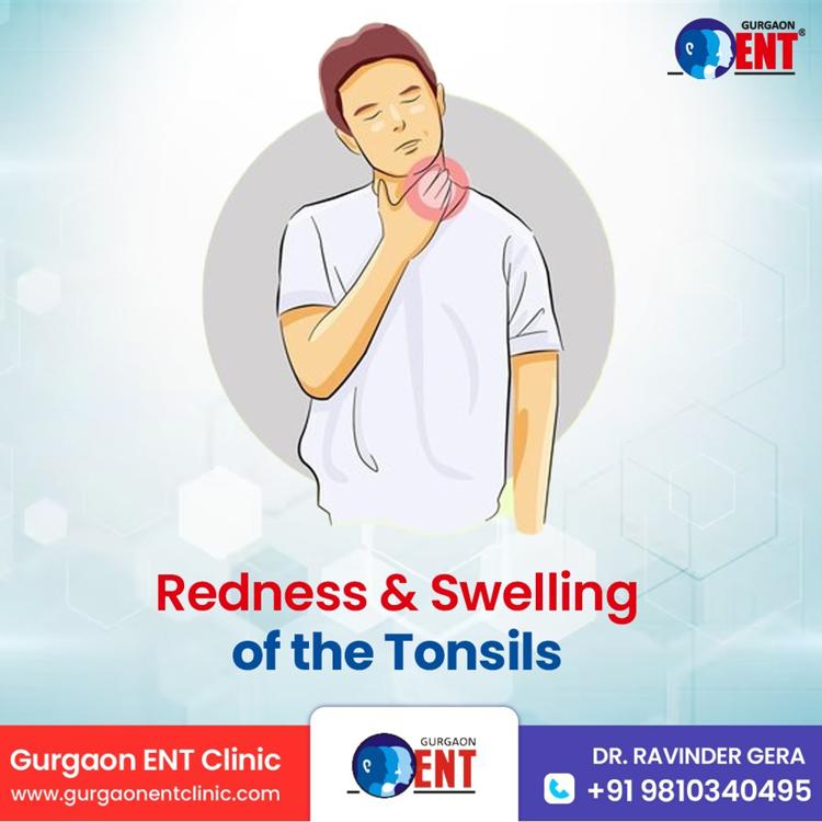 Redness  Swelling Of The Tonsils.jpg