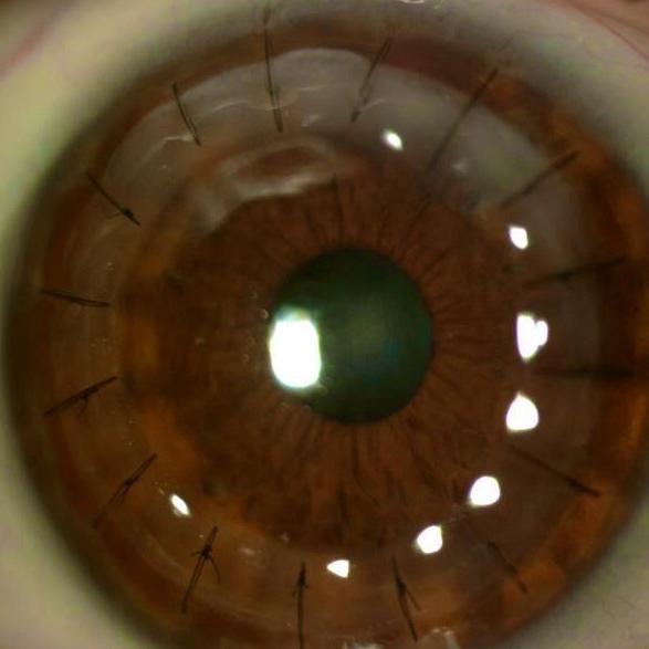 Transplante de cornea DALK