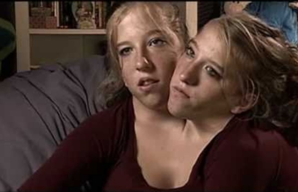 Abigail & Brittany Hensel - The Twins Who Share a Body