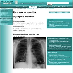 Radiology Masterclass - Chest tutorials - Chest x-ray abnormalities - Diaphragmatic abnormalities