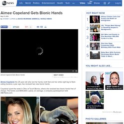 Aimee Copeland Gets Bionic Hands