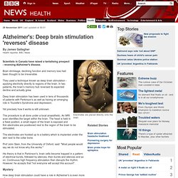 Alzheimer's: Deep brain stimulation 'reverses' disease