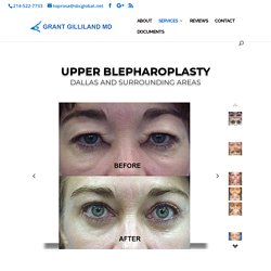 Upper Blepharoplasty - Blepharoplasty/Cosmetic/Eyelid Surgery/Graves/Dallas/Grant Gilliland