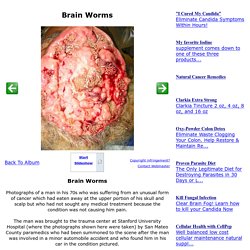 Brain Worms On CureZone Image Gallery