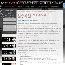 Brow Lift Atlanta, GA