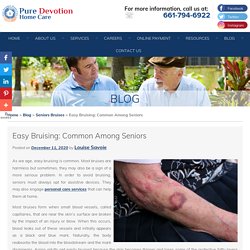 Easy Bruising: Common Among Seniors
