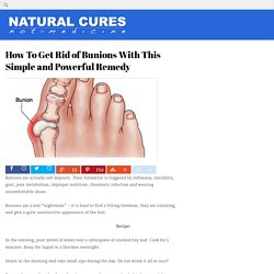 How To Get Rid of Bunions With This Simple and Powerful Remedy