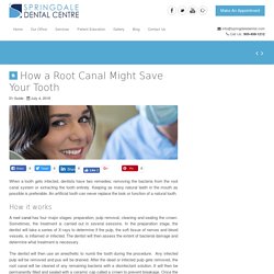 How a Root Canal Might Save Your Tooth - Springdale Dental Centre