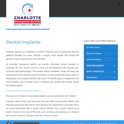 Affordable Dental Implants in Charlotte NC