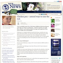 Chicken pox – natural ways to ease the itch