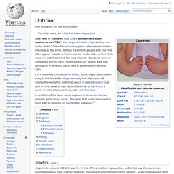 Club foot - Wikipedia
