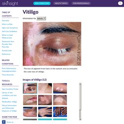 Vitiligo in Adults: Condition, Treatments, and Pictures - Overview