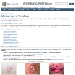 Cutaneous lupus erythematosus. DermNet NZ