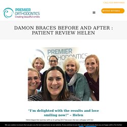 Damon Braces before and after patient review helen