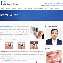 Dental Implant In Delhi At M R Dental Centre