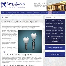 6 Different Types of Dental Implants