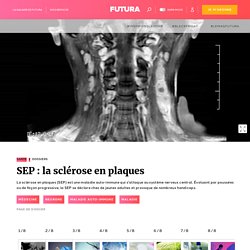 Dossier > SEP : la sclérose en plaques