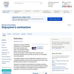 Dupuytren's contracture