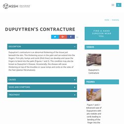Dupuytrens Contracture - Causes, Symptoms, and Treatment