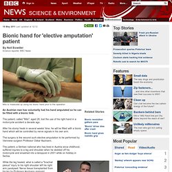 Bionic hand for 'elective amputation' patient