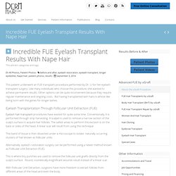 Eyelash Transplant- Patient Surgery With Nape Hair