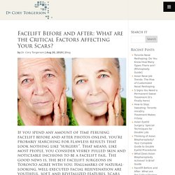Facelift Before and After: The Critical Factors Affecting Your Scars