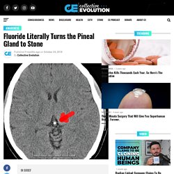 Fluoride Literally Turns the Pineal Gland to Stone