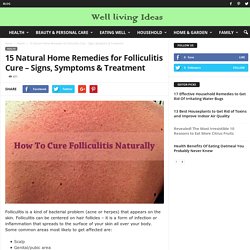 15 Natural Home Remedies for Folliculitis Cure – Signs, Symptoms & Treatment