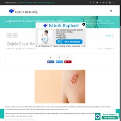 Gejala Cacar Air atau Herpes Varicella Zoster