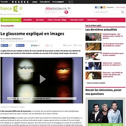 Le glaucome expliqué en images