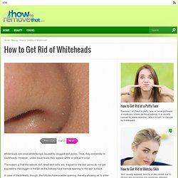 How to Get Rid of Whiteheads - How to remove that