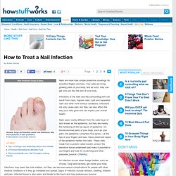 How to Treat a Nail Infection"