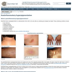 Postinflammatory hyperpigmentation. DermNet NZ