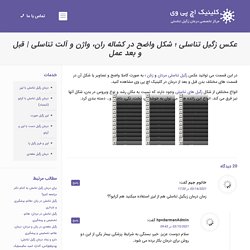 عکس زگیل تناسلی ؛ شکل واضح در کشاله ران، واژن و آلت تناسلی