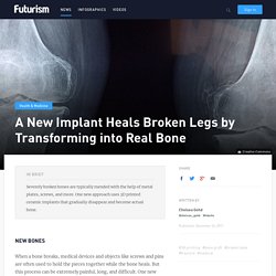 This implant could transform the way we fix broken bones