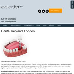 Dental Implants in Mill Hill & Barnet Teeth Whitening Invisalign