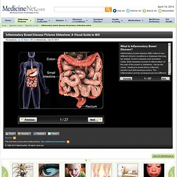 Inflammatory Bowel Disease Pictures Slideshow: A Visual Guide to IBD on MedicineNet