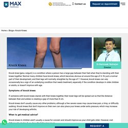 Knock Knees - Max Hospital India