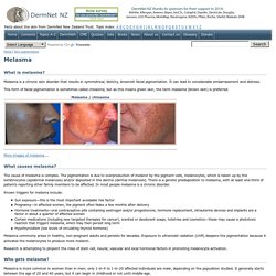 Melasma (facial pigmentation). DermNet NZ