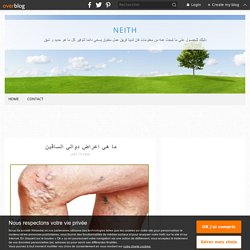 ما هي اعراض دوالي الساقين - neith