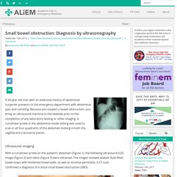 Small bowel obstruction: Diagnosis by ultrasonography