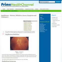 Papilledema – Pictures, Definition, Causes, Symptoms and Treatment