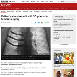 Patient's chest rebuilt with 3D print after tumour surgery