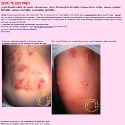- DERMATOLOGIE dermite des prés phototoxicité plantes allergie soleil Phytophotodermatitis furocoumarins -
